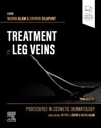 Treatment of Leg Veins